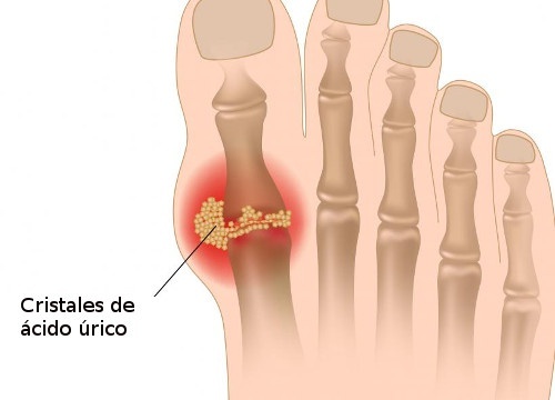 Ácido úrico: o que é e como controlá-lo