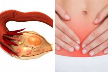 Câncer de ovário: 7 sinais deste assassino silencioso