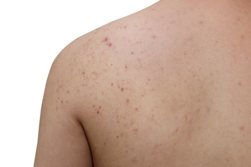 acne-ombros