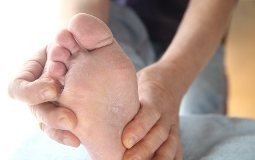 O pé de atleta: tratamentos e métodos de prevenção