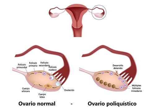 Ovarios