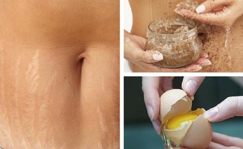 Recomendações para evitar ou atenuar estrias Recomendações para evitar ou atenuar estrias