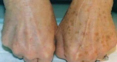Como atenuar as manchas na pele com plantas medicinais