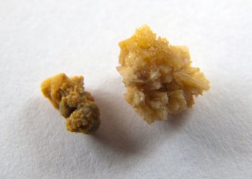 Existem alimentos que podem causar pedras nos rins?