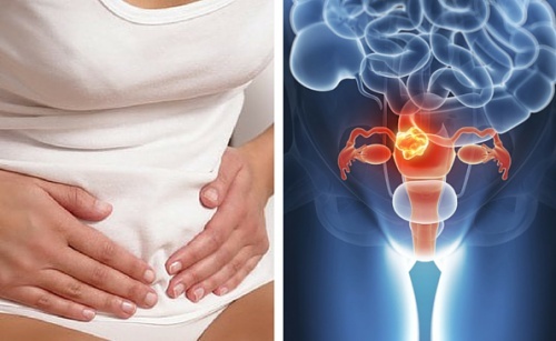 Câncer de colo do útero: tudo o que precisamos saber