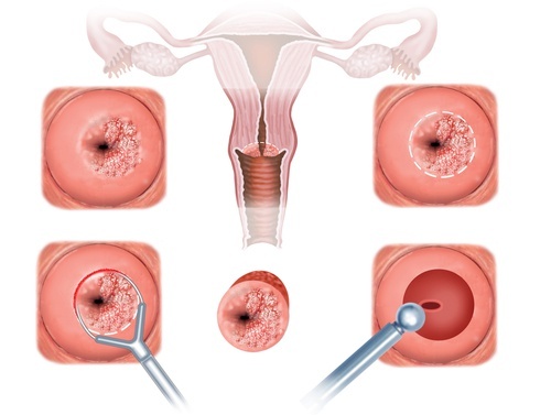 Possíveis sinais de câncer do colo do útero