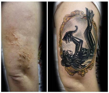 tatuagens_vitimas_de_violencia_queimadura