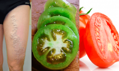 Tomates para reduzir a dor causada pelas varizes