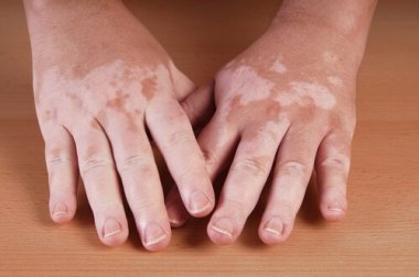 Tratamentos naturais para o vitiligo
