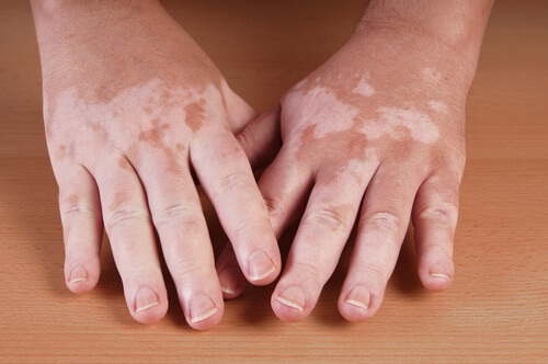 Tratamentos naturais para o vitiligo