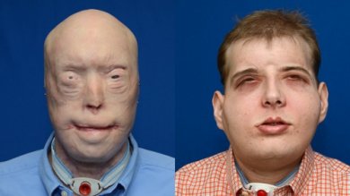 Bombeiro de 41 anos recebe transplante facial mais completo da história