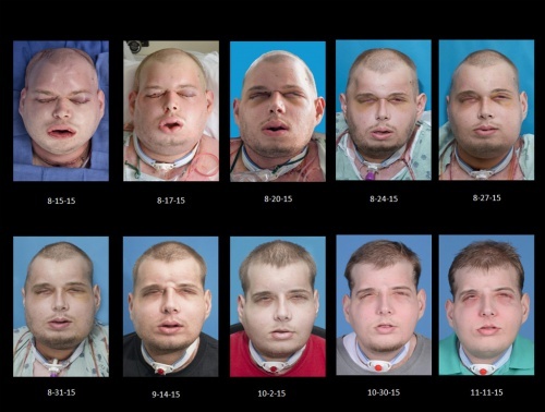 transplante facial etapas