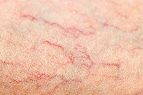 Como tratar as varizes das pernas