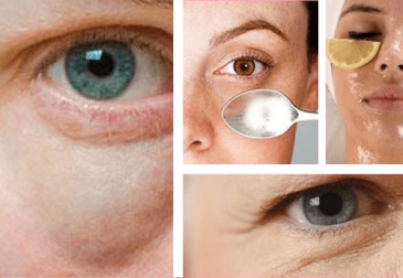 Bolsas embaixo dos olhos! Dicas simples para combatê-las
