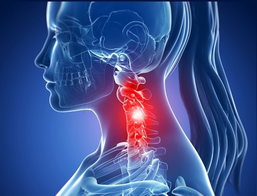Espondilose cervical: sintomas e tratamentos naturais