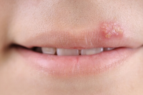 Como evitar ou tratar a herpes labial