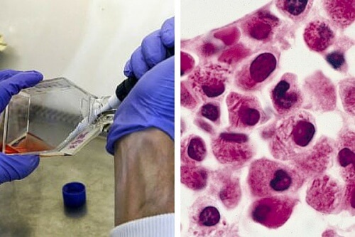 Cientistas fazem com que células de leucemia se destruam
