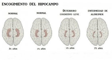 Aprenda a reconhecer os 10 principais sintomas da doença de Alzheimer