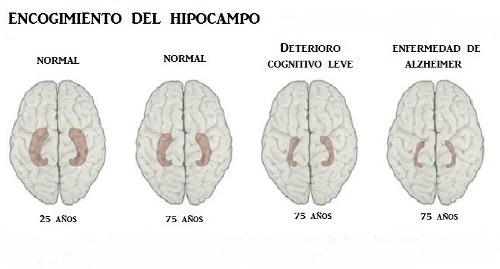 Aprenda a reconhecer os 10 principais sintomas da doença de Alzheimer