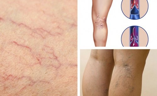 4 remédios herbais que ajudam a diminuir as varizes e aranhas vasculares