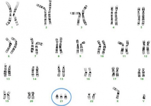 Cromossomas e a síndrome de Down