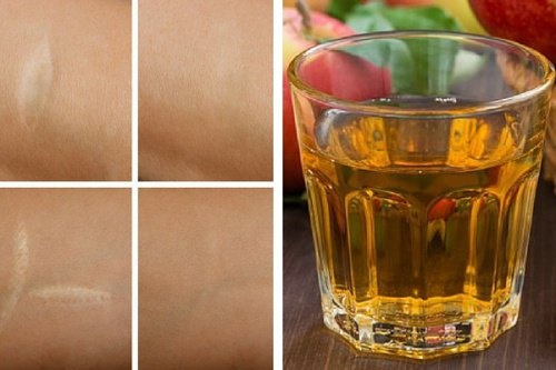 Tônico antioxidante para as rugas, queimaduras de sol e cicatrizes