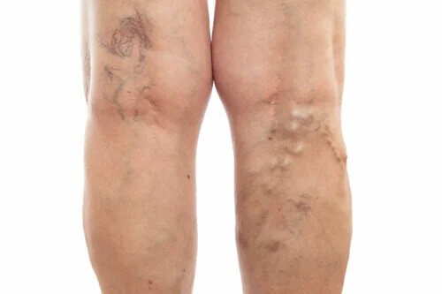 Pernas inchadas podem indicar um problema de saúde mais sério