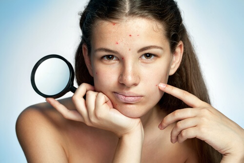 efeitos-estresse-acne