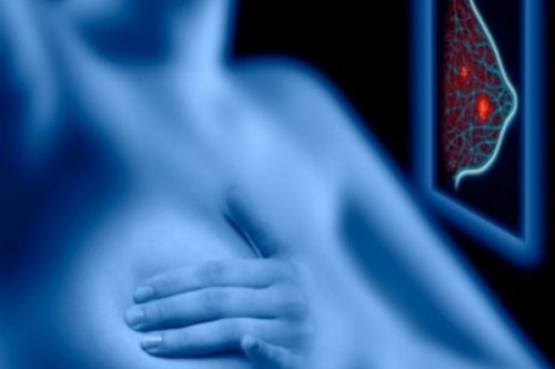 Mamografias: os riscos superam os benefícios?