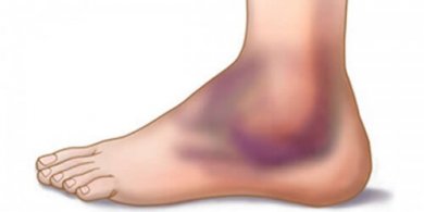 Entorses: por que ocorrem? Como são tratadas?