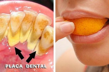 Placa dental: 5 remédios naturais para combatê-lá