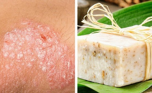 Receita de sabonete caseiro para peles com eczema