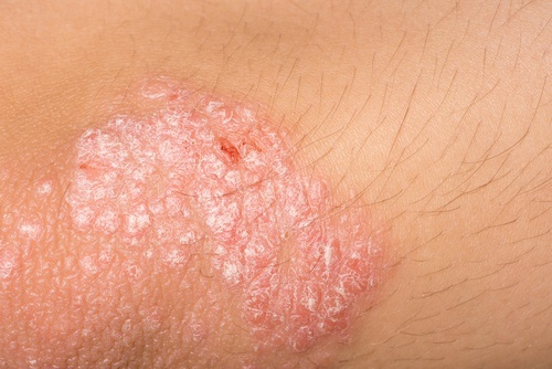 Pele com eczema que precisa ser tratada com sabonete caseiro
