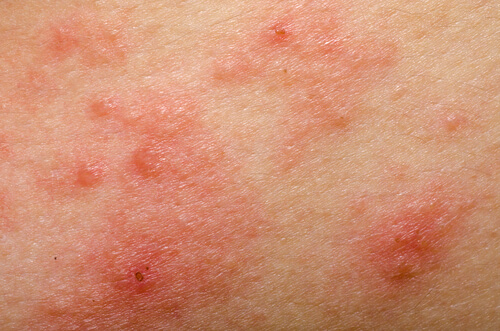 Rosacea-na-pele