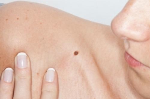 Algumas pintas podem ser sintomas de câncer de pele