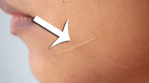 Como atenuar as cicatrizes da pele?