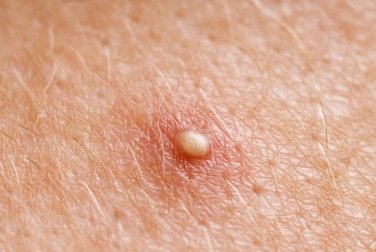 Como eliminar os cistos de gordura com remédios caseiros