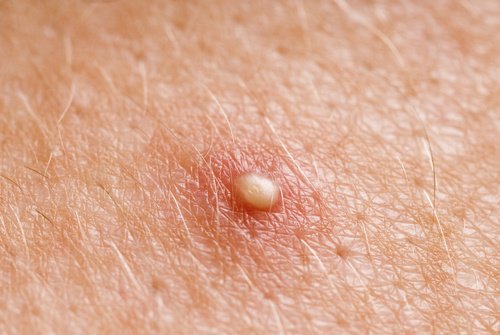 Como eliminar os cistos de gordura com remédios caseiros Como eliminar os cistos de gordura com remédios caseiros