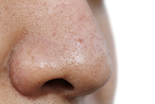 5 máscaras faciais para remover os cravos 5 máscaras faciais para remover os cravos