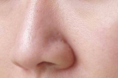 É possível fechar os poros de forma natural?