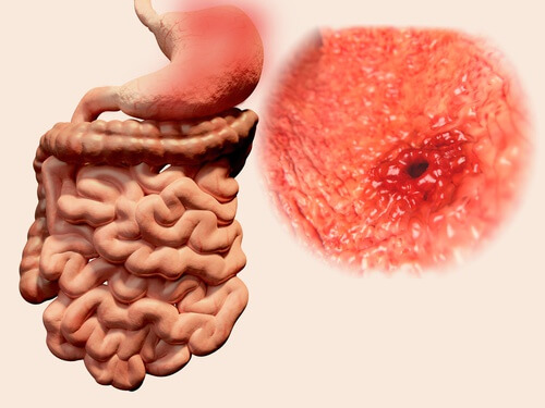 5 sucos naturais para aliviar as úlceras gástricas 5 sucos naturais para aliviar as úlceras gástricas