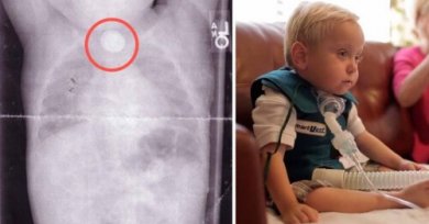 Conheça a história do bebê que sofreu danos irreparáveis por engolir uma pilha de botão