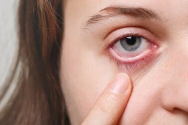 5 remédios para a síndrome dos olhos secos