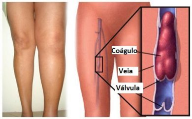 5 coisas que você pode fazer para prevenir a trombose