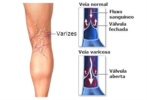varizes_remedio_natural_com_aloe_vera