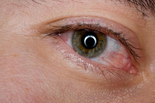 6 remédios caseiros para aliviar a sensação de olhos cansados