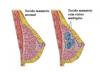 Dicas para prevenir e detectar a tempo os cistos nos seios