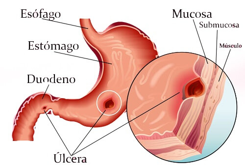 Receitas caseiras para tratar úlceras no estômago