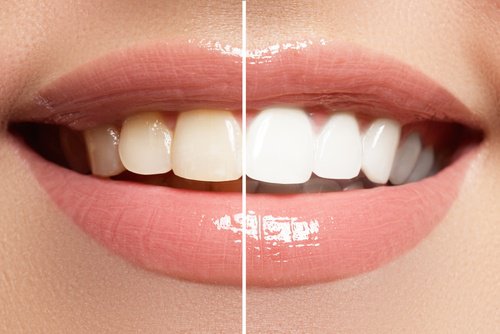 Limão como clareador dental