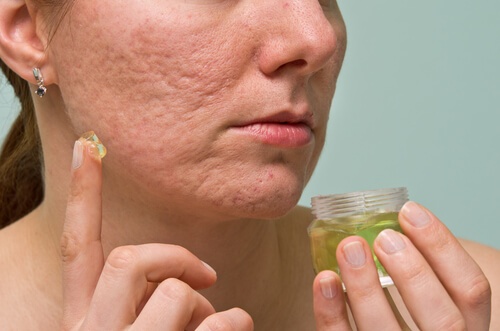 Combater a acne com água oxigenada